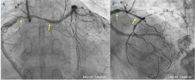 Case Report: Rare percutaneous coronary intervention for “right” main bifurcation